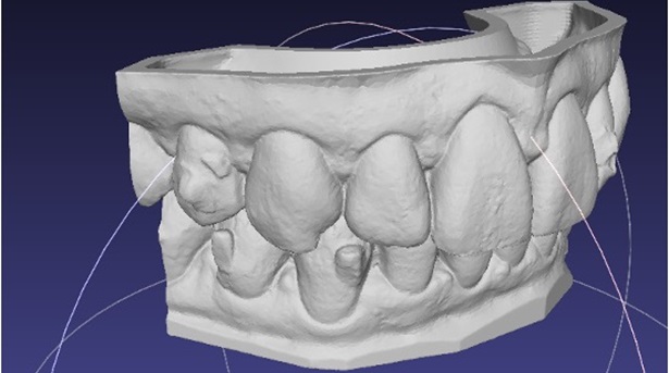 Modèle d'orthodontie pour contention fixe réalisé par EasyModel