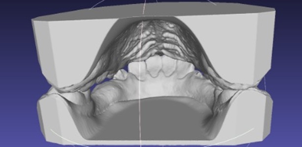 Modèle d'étude d'orthodontie réalisé automatiquement par EasyModel